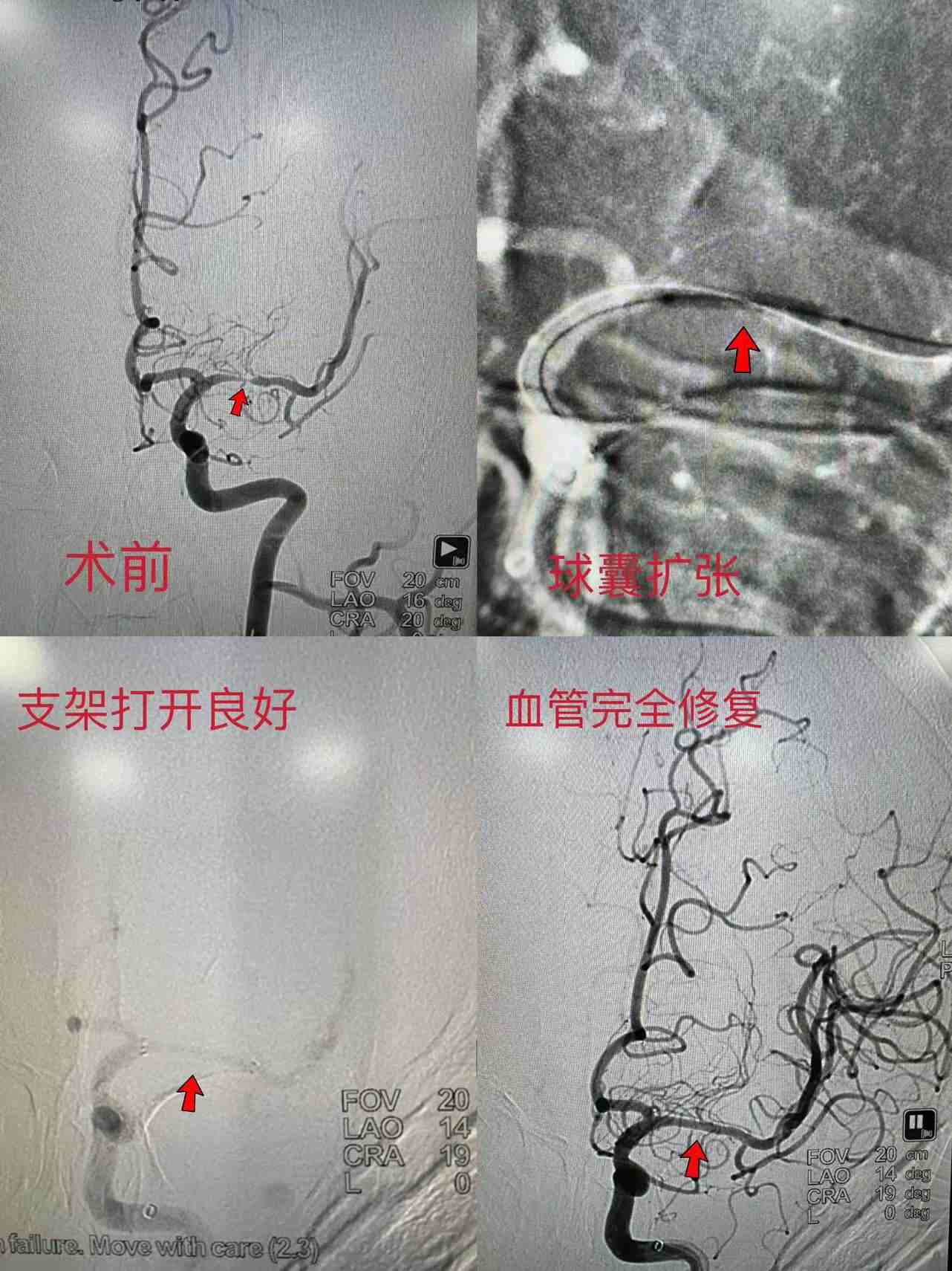 新疆醫(yī)科大學(xué)第七附屬醫(yī)院神經(jīng)內(nèi)科開展院內(nèi)首例左側(cè)大腦中動脈支架植入術(shù)