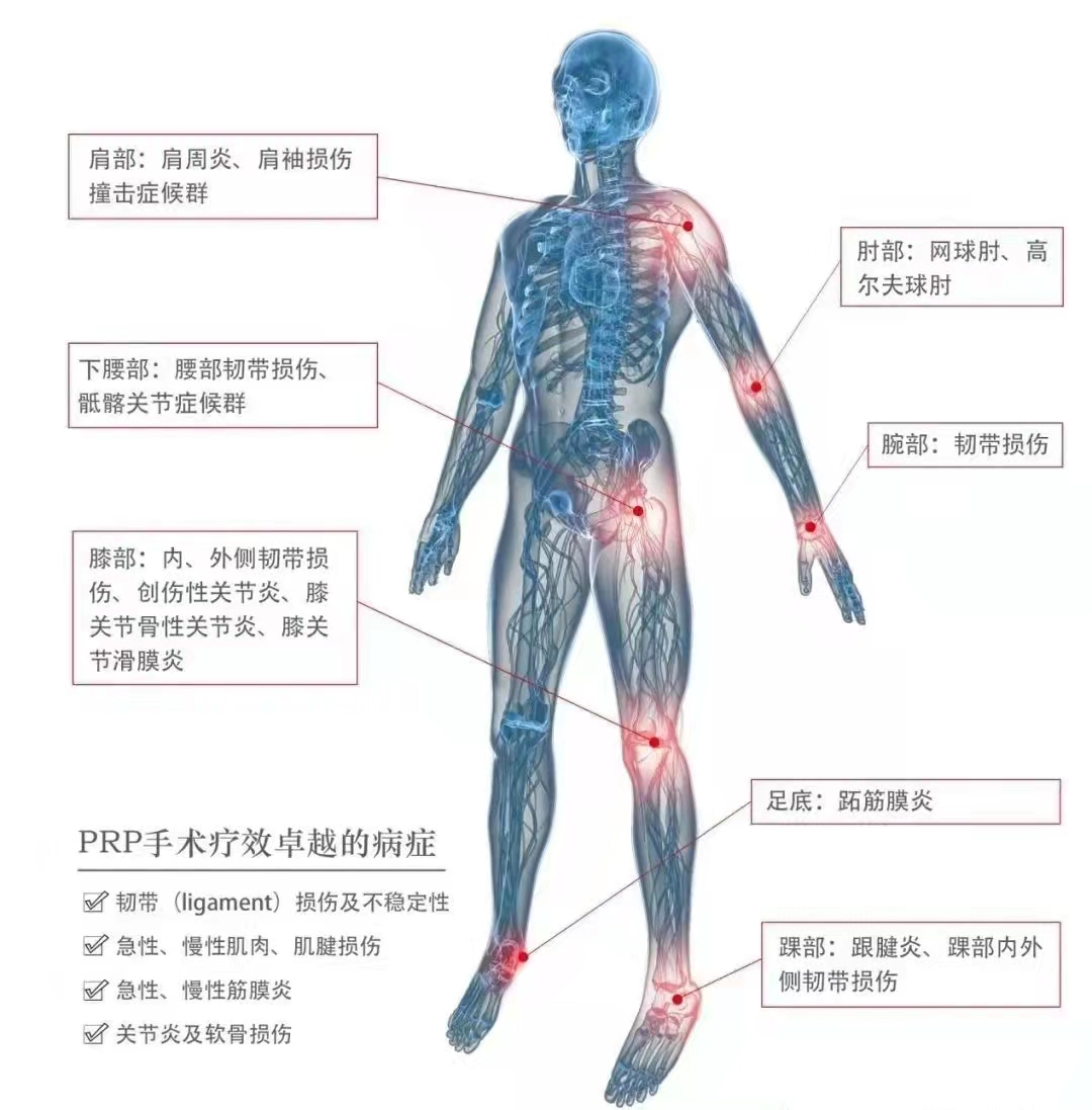 【新技術】骨關節疾病患者的福音！新醫大七附院開展PRP（富血小板血漿）治療
