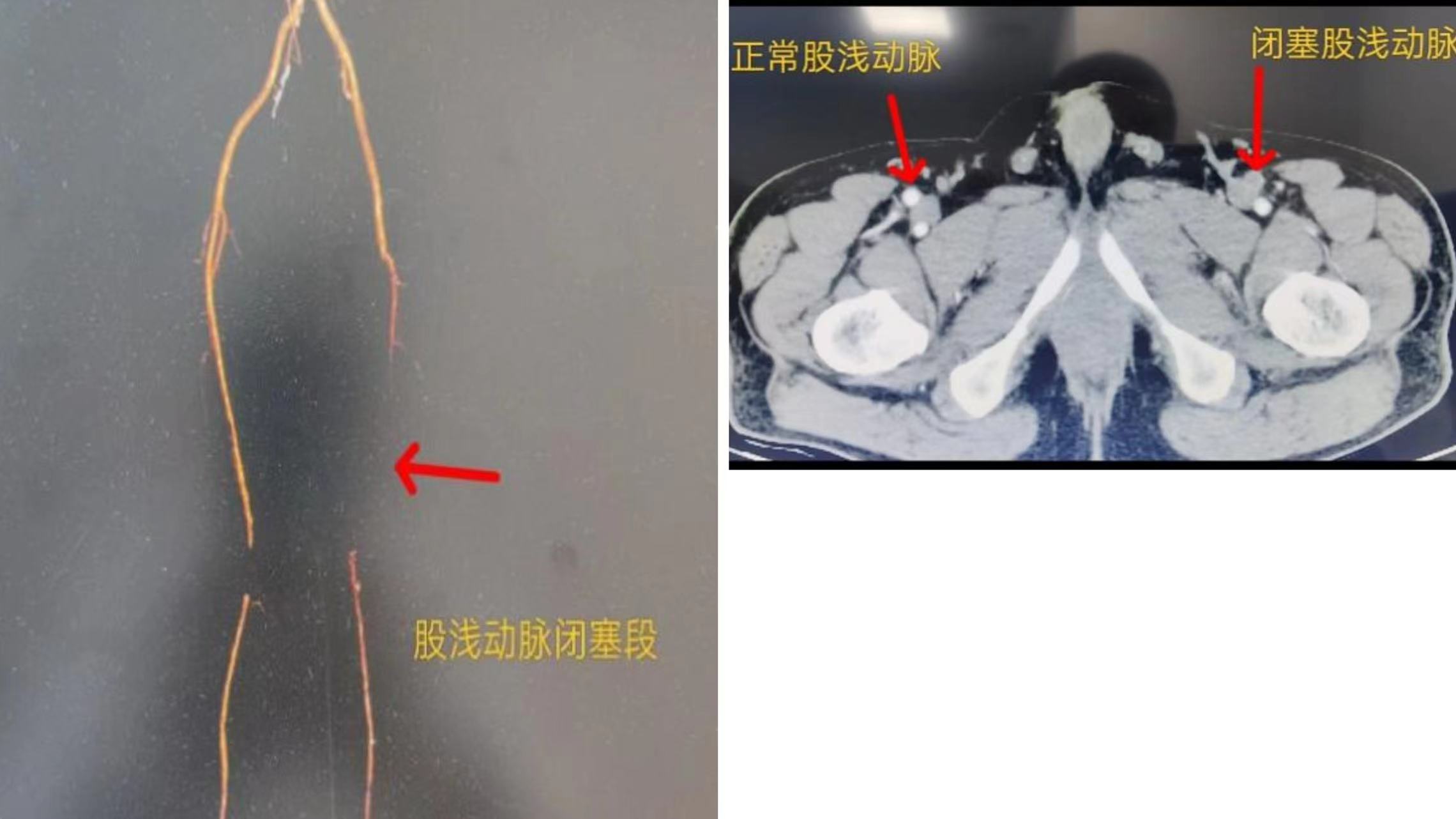 知“足”方能常樂——我院成功完成首例下肢動脈慢性閉塞開通手術