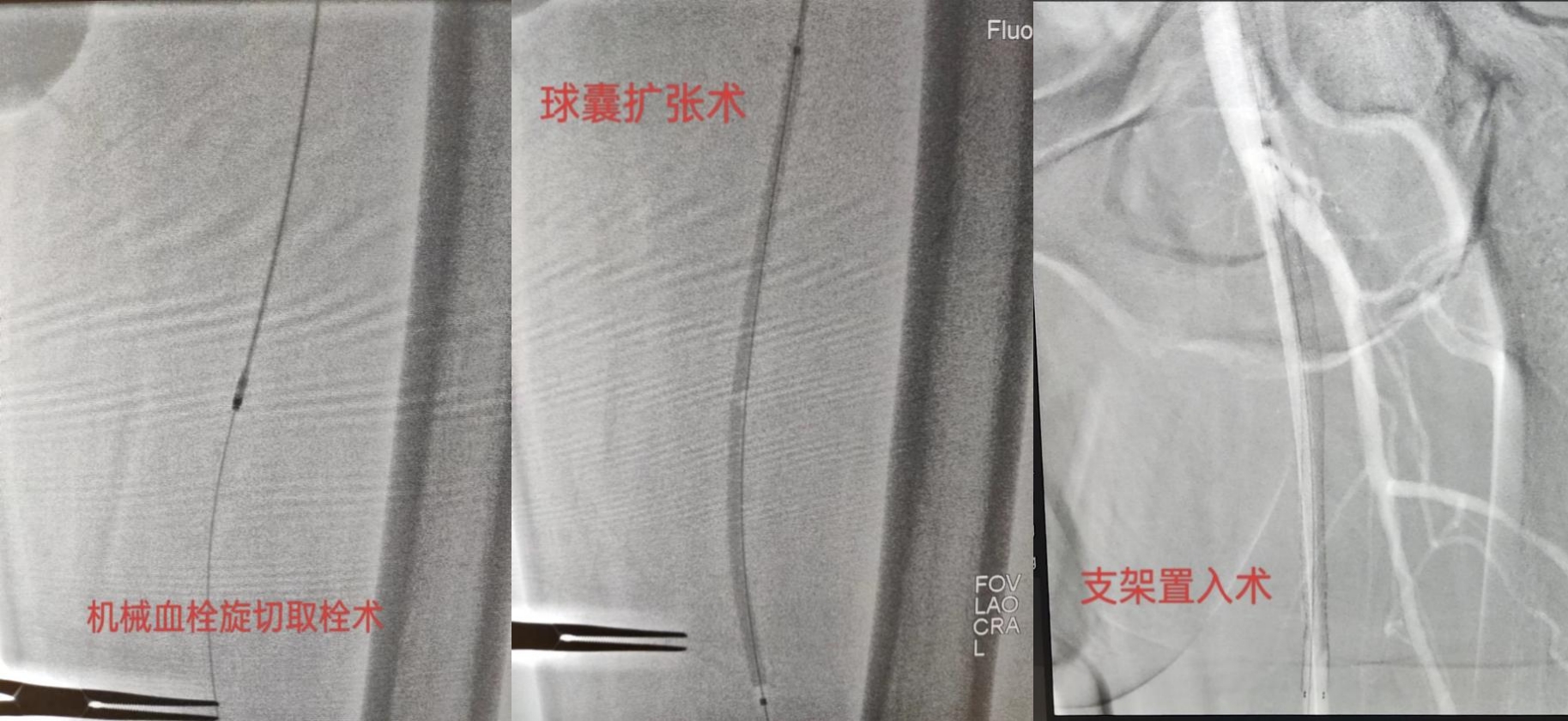 知“足”方能常樂——我院成功完成首例下肢動脈慢性閉塞開通手術