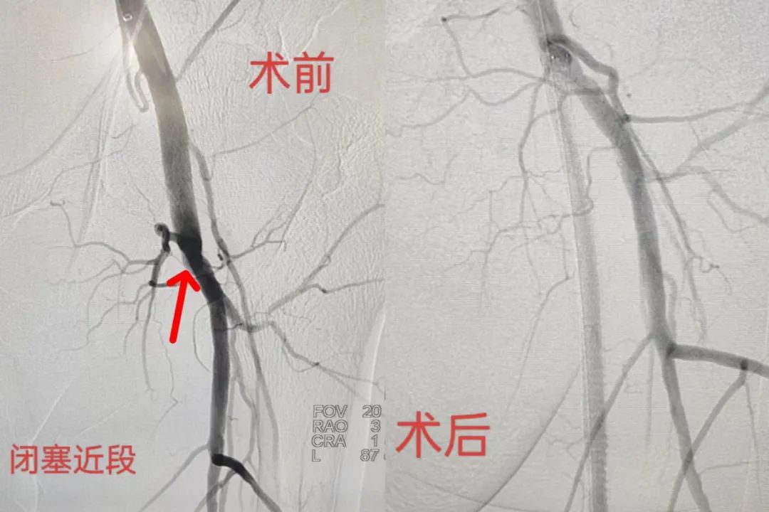 知“足”方能常樂——我院成功完成首例下肢動脈慢性閉塞開通手術