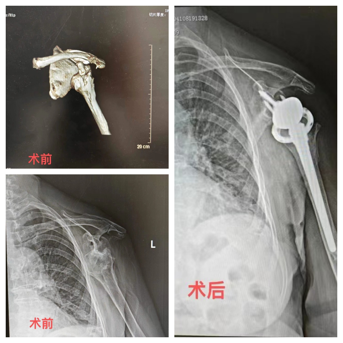 反肩置換手術，“報廢”的肩關節重獲新生