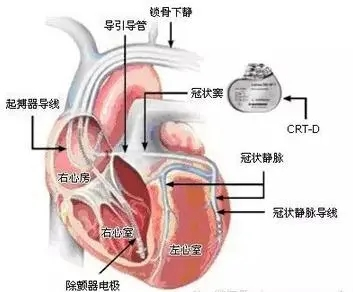我院成功實(shí)施首例心臟再同步除顫器 (CRT-D) 的植入手術(shù)