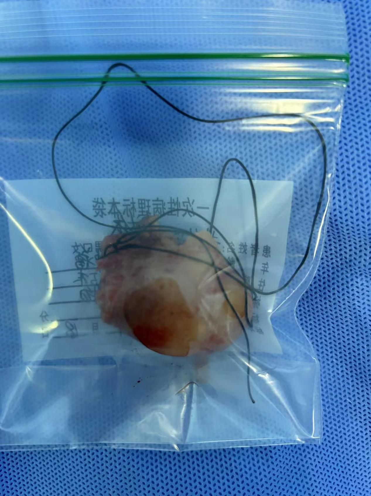 乳腺微創手術新時代-術后“無痕”，“乳”此美麗